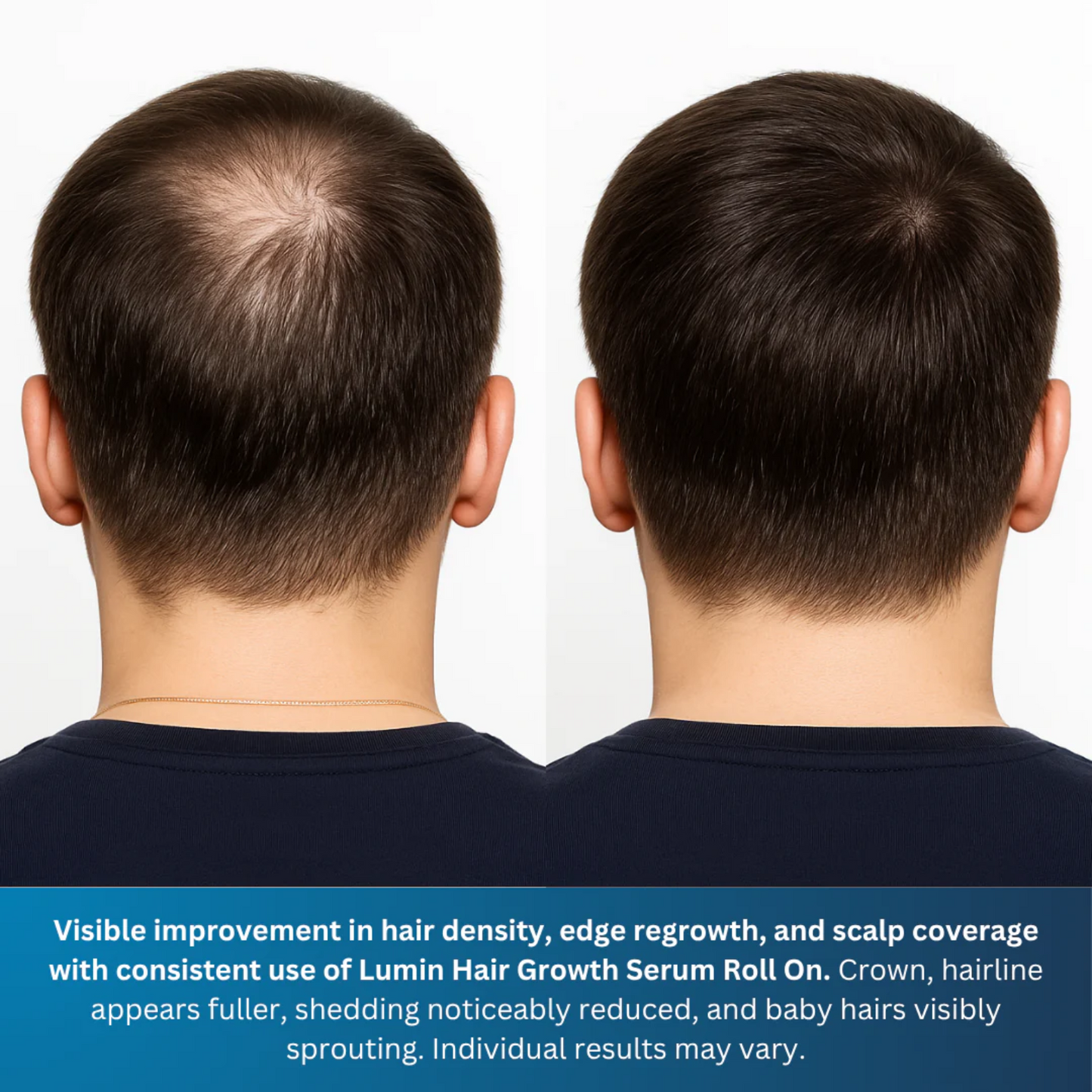 Advanced Hair Growth Roll-On Serum