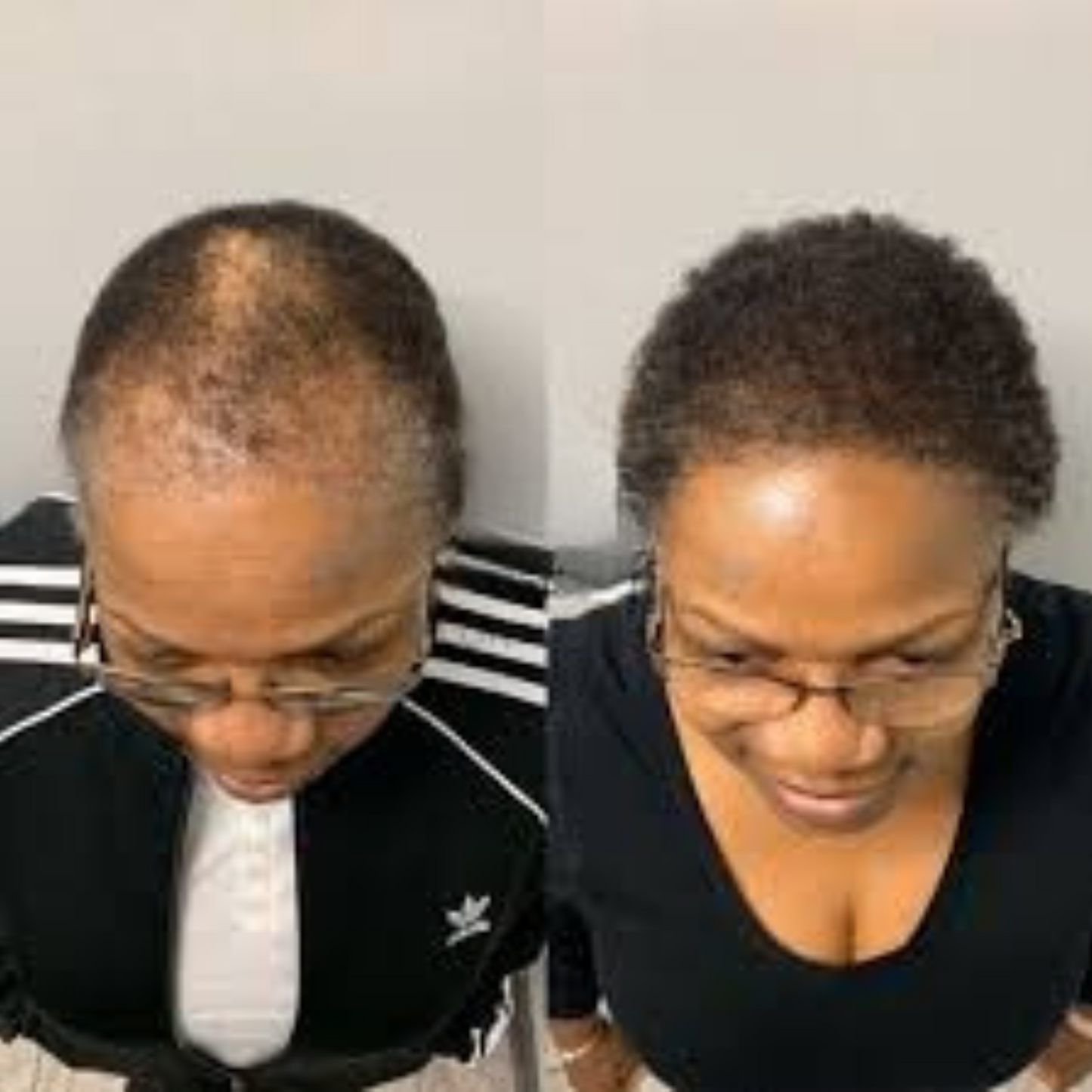 Regrow Thicker, Fuller Hair Naturally