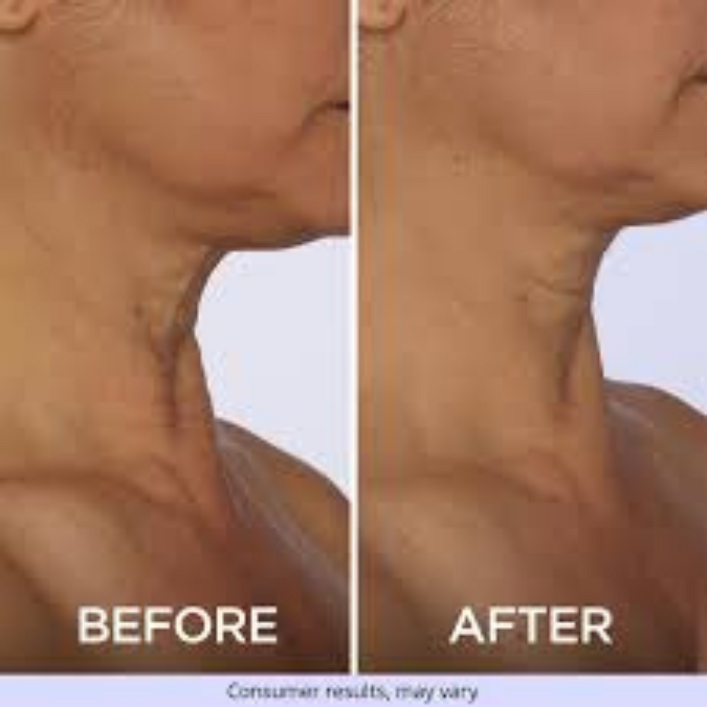 Neck-Lift Pro